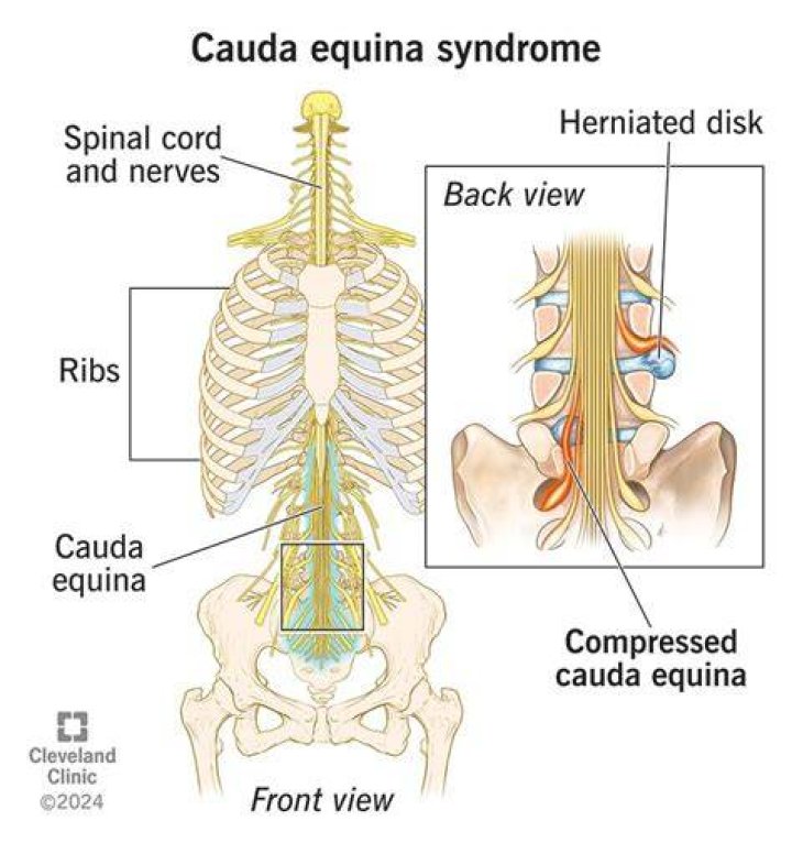 Can cauda equina be treated without surgery?