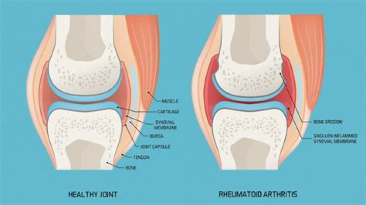 Can you have rheumatoid arthritis and it not showing up in blood work?