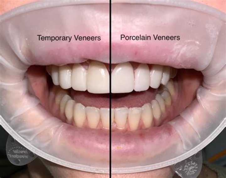Do temporary veneers stain easily?