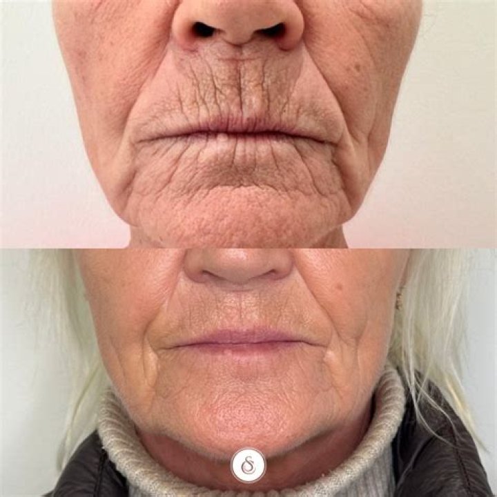Does smoking dissolve lip filler?