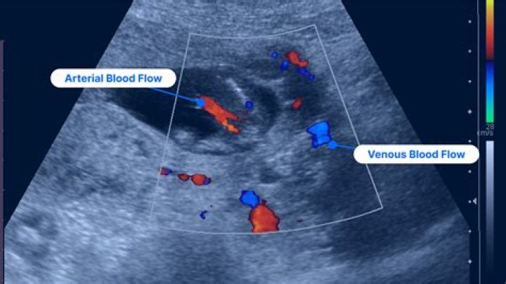 Does ultrasound have side effects?