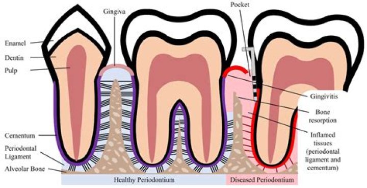 How do you regrow bone loss from periodontal disease naturally?