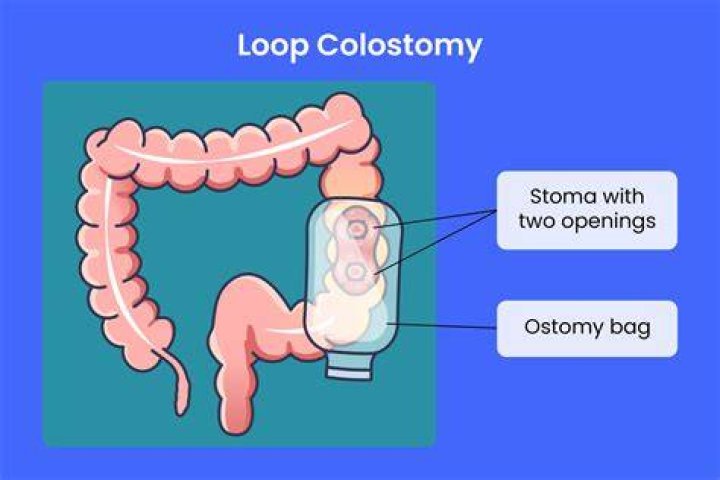 How often do you poop with a stoma?