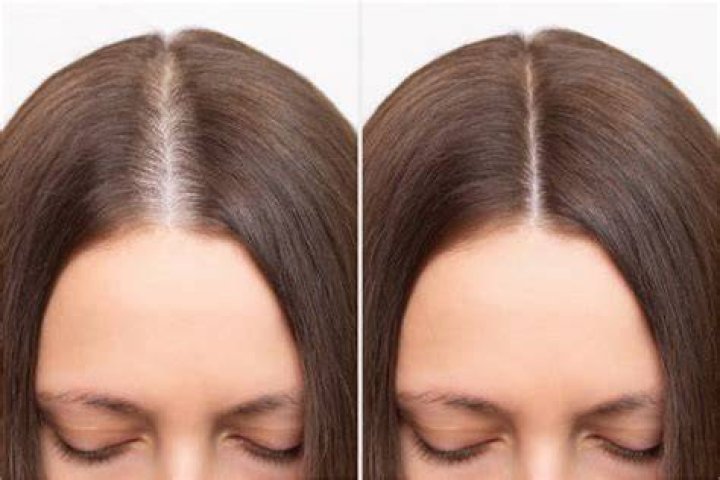 Is hair thinning permanent?