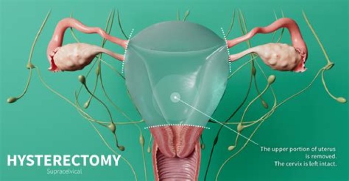Should I get a hysterectomy if I have precancerous cells?
