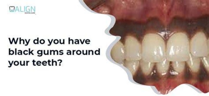 What does black gums around a tooth mean?