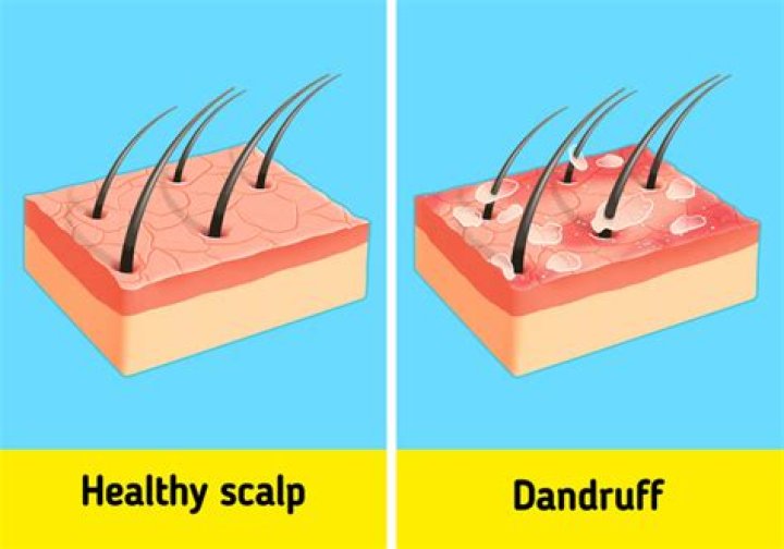 What is dandruff made of?