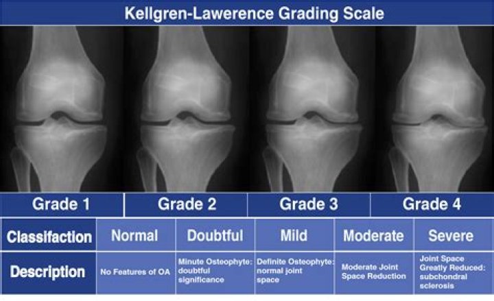 What is the most severe arthritis?