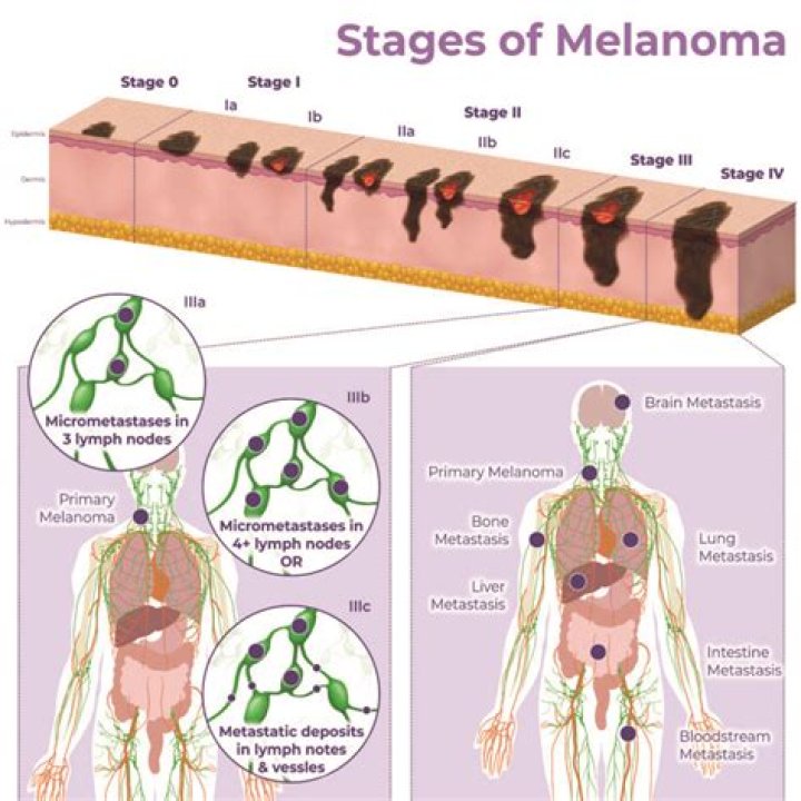 Where does melanoma spread to first?