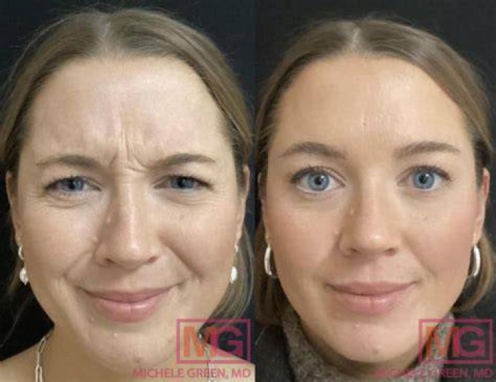 Why do I still have wrinkles after Botox?